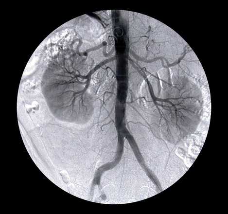 Arterie